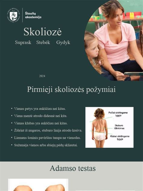 Skoliozės iliustracija