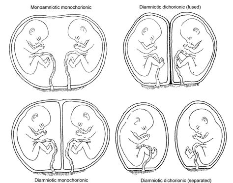 Diagram of twin pregnancy types