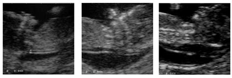 Ultragarsinis matavimas - sprando vaiskumos matavimas