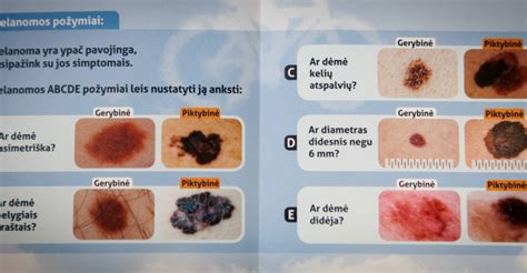 Odos pigmentiniai apgamai