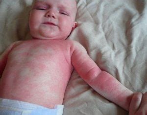 kūdikio oda su egzemos požymiais