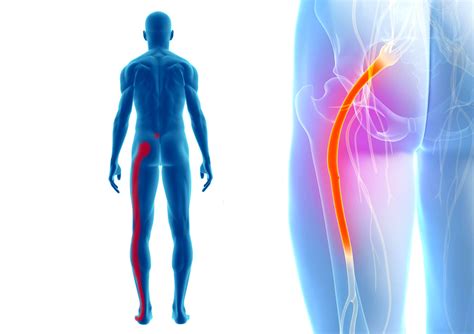 Anatomija. Sėdimasis nervas ir jo santykis su kriaušiniu raumeniu.