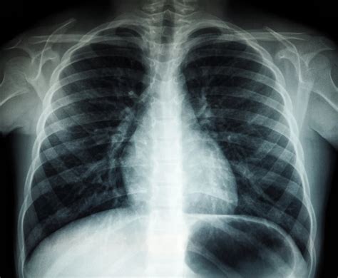 Vaiko krūtinės ląstos rentgeno nuotrauka