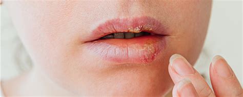 Herpes viruso sukeltas gingivostomatitas kūdikiui