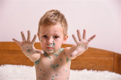 vaikas su vėjaraupių bėrimu