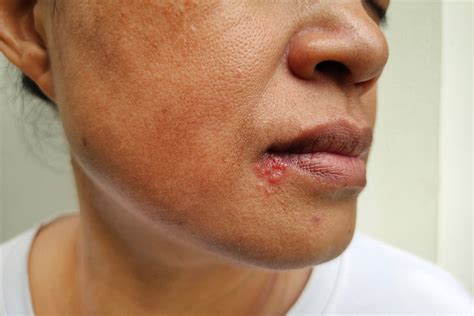 Herpes ant lūpos eiga