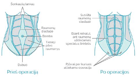 Nėščiosios pilvo augimo schematinis vaizdavimas