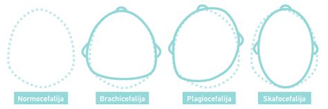 Kūdikio galvytės deformacijų tipai