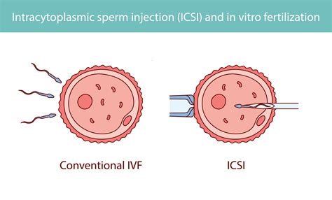 Schema, iliustruojanti IUI ir IVF procedūras
