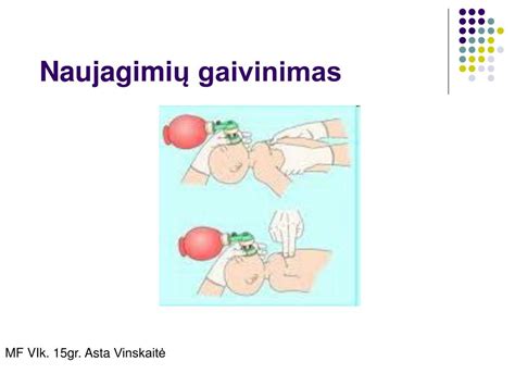 Naujagimio gaivinimas