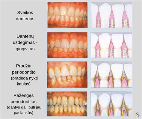 Nėštumo gingivito simptomai: paraudusios, patinusios ir kraujuojančios dantenos