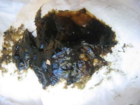 Pirmasis kūdikio šlapimas gali būti rausvas