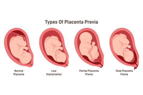 Placenta previa ultragarsinis vaizdas