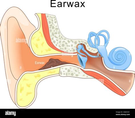 schema of ear canal with earwax plug