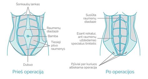 Pilvo raumenų diastazės schema