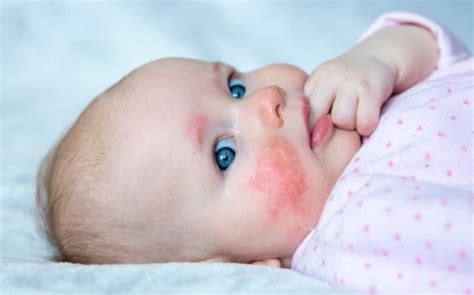 Kūdikis su pūlinėliu ant odos