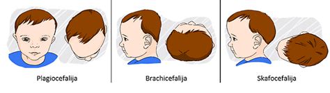 Kraniosinostozės sukeltos kaukolės deformacijos